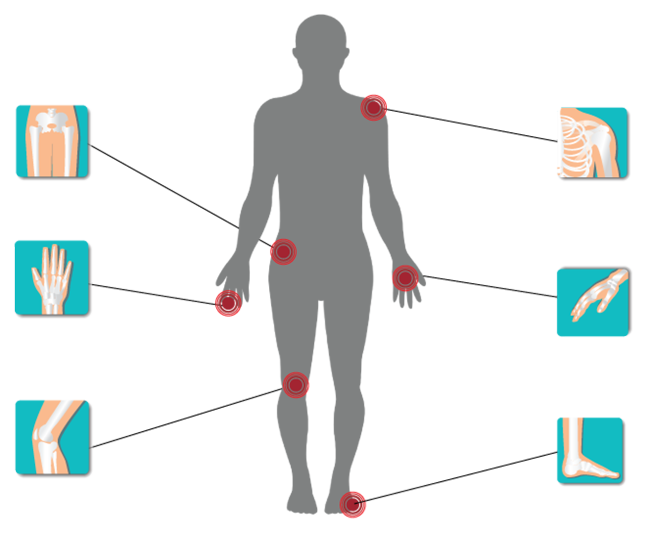 Polyarthrite rhumatoïde symptômes et diagnostic Lilly