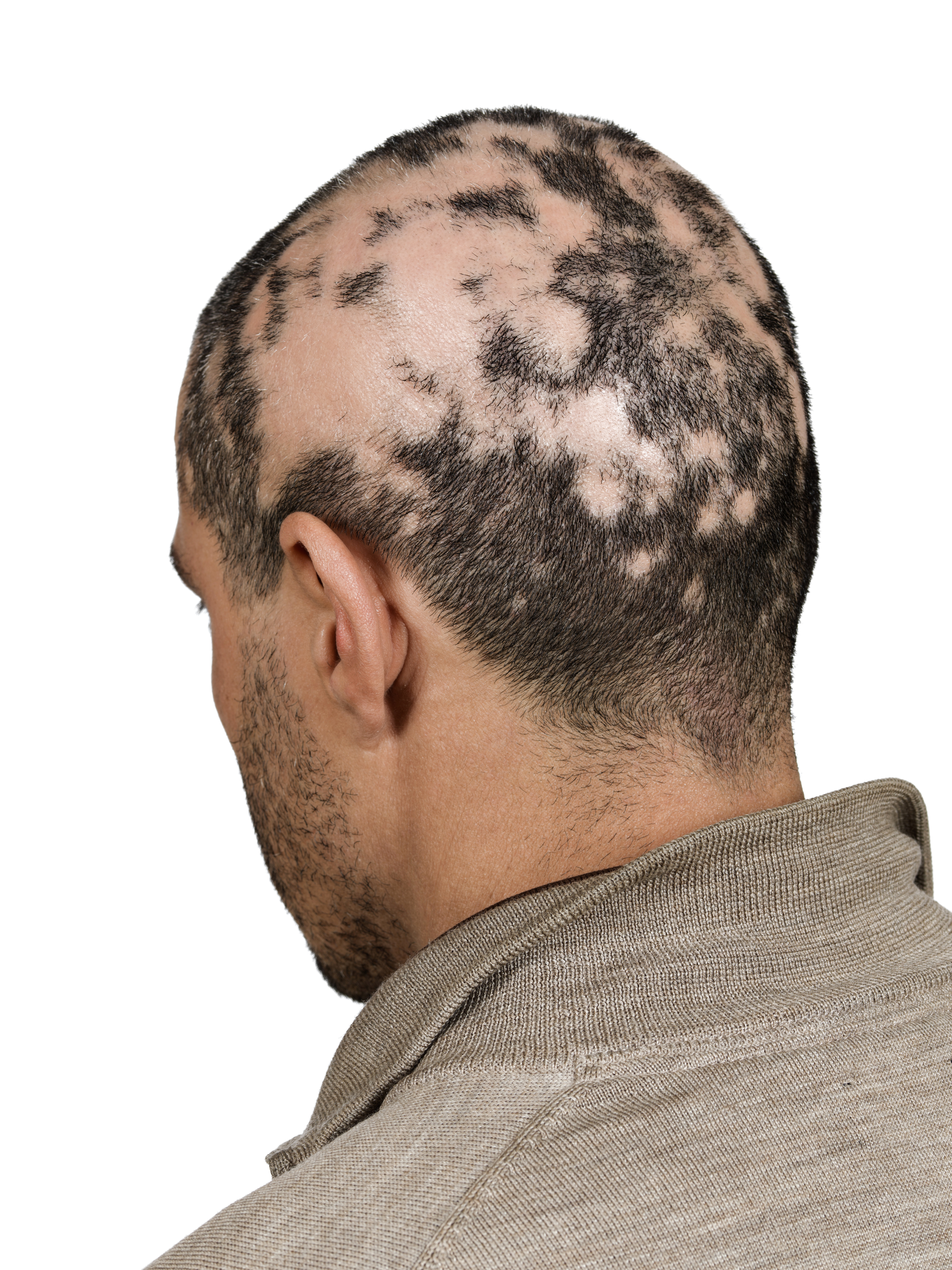 Patient atteint de pelade ou alopecia areata