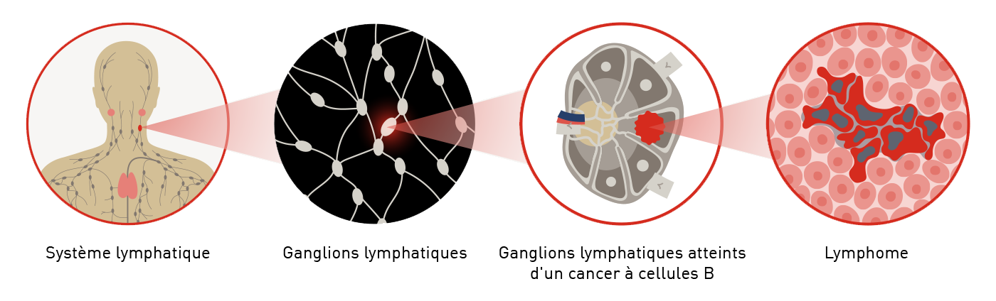 Lymphome à cellules du manteau 